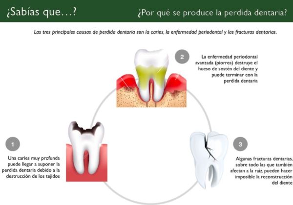 Por qué se produce la pérdida de dientes