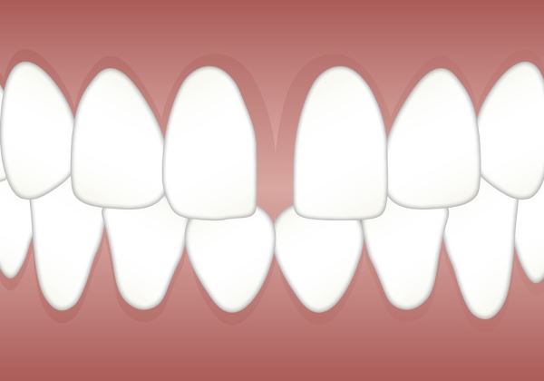 DIASTEMA O DIENTES SEPARADOS