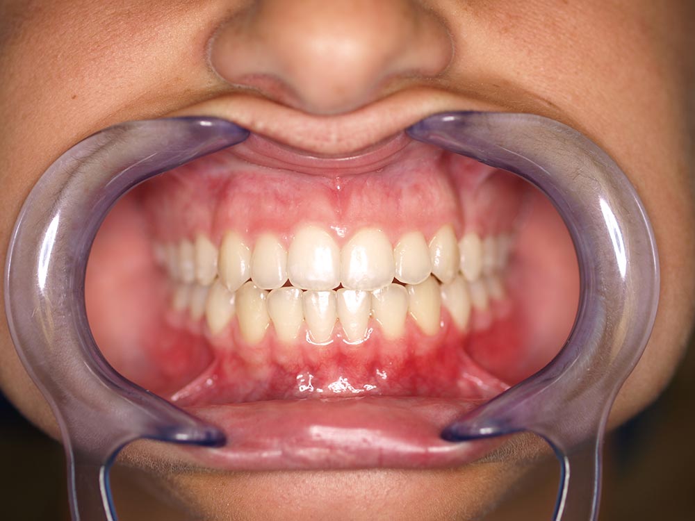 Orthodontic cases