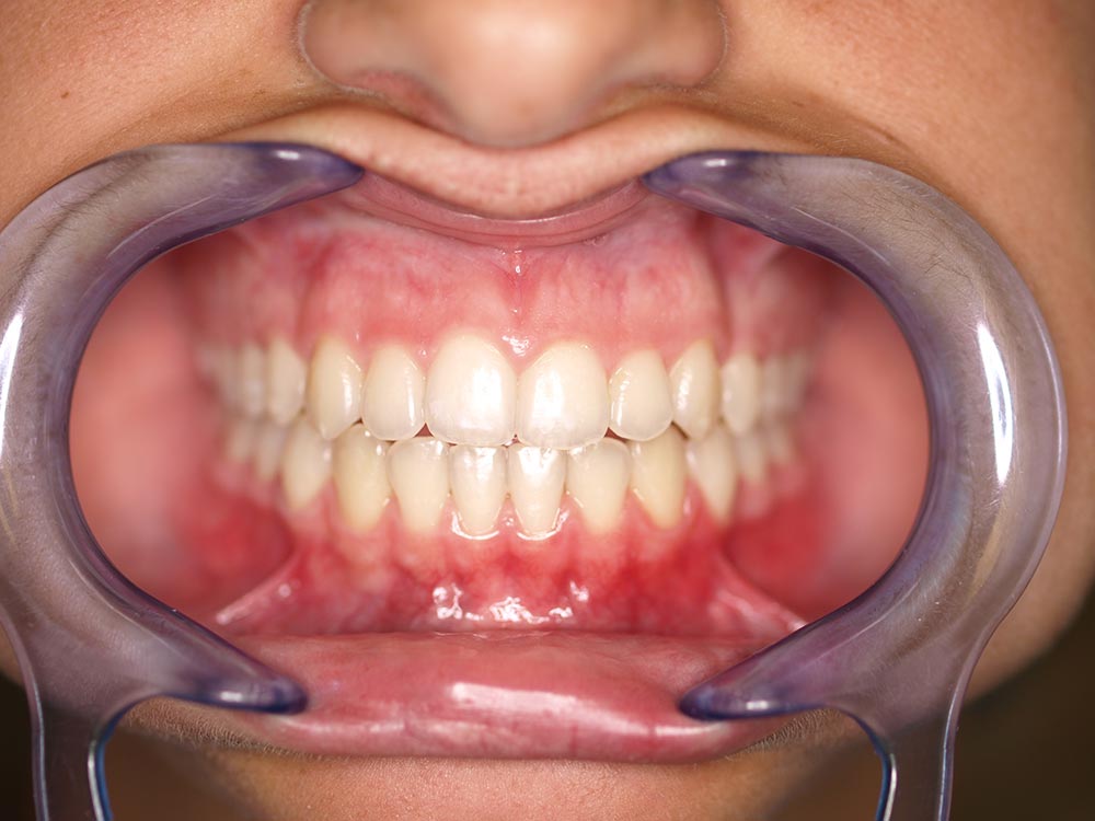 Orthodontic cases