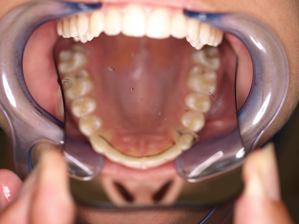 Orthodontic cases