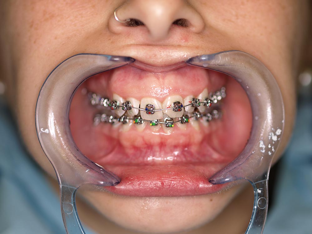 Orthodontic cases