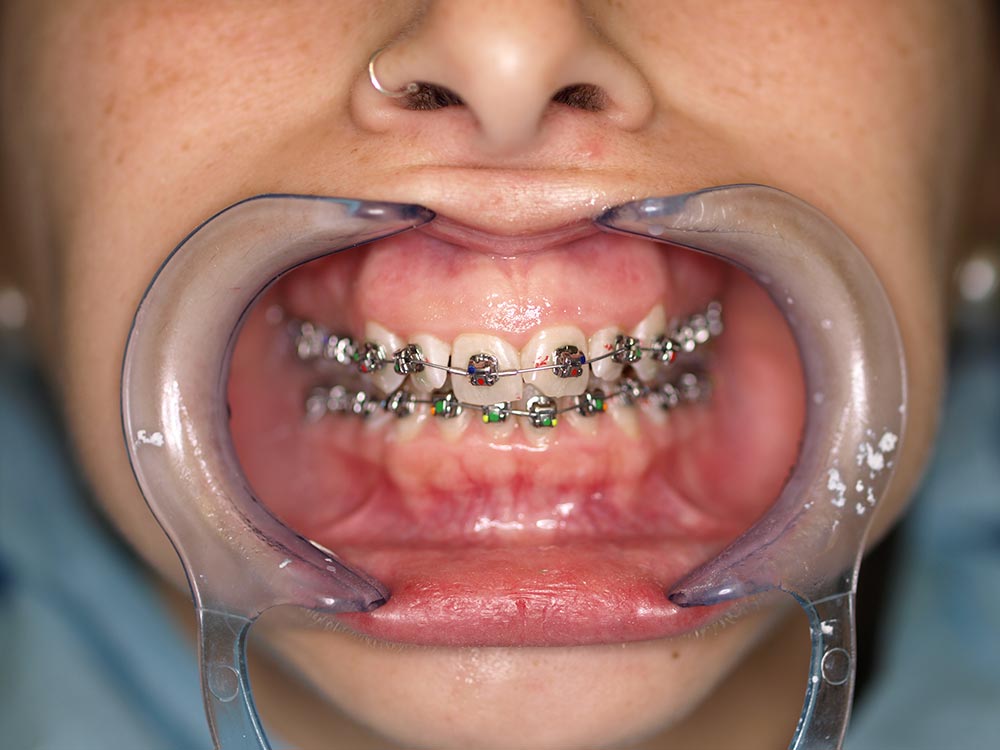 Orthodontic cases