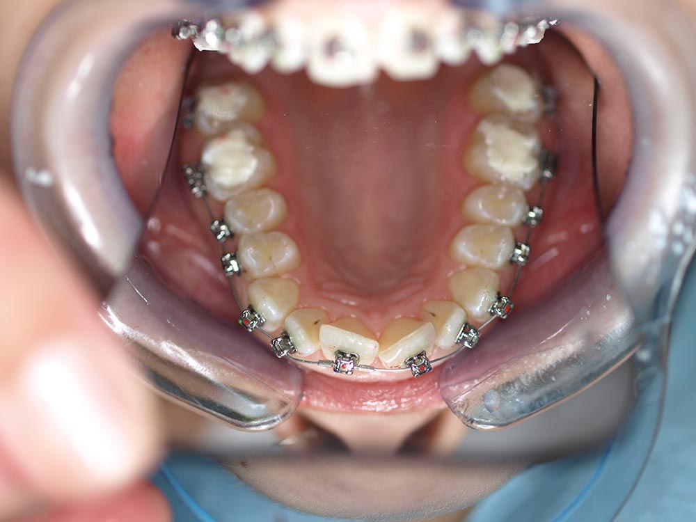 Orthodontic cases