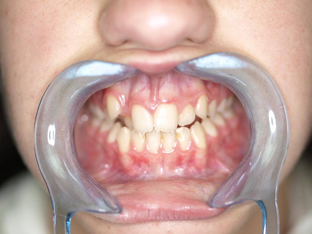 Orthodontic cases