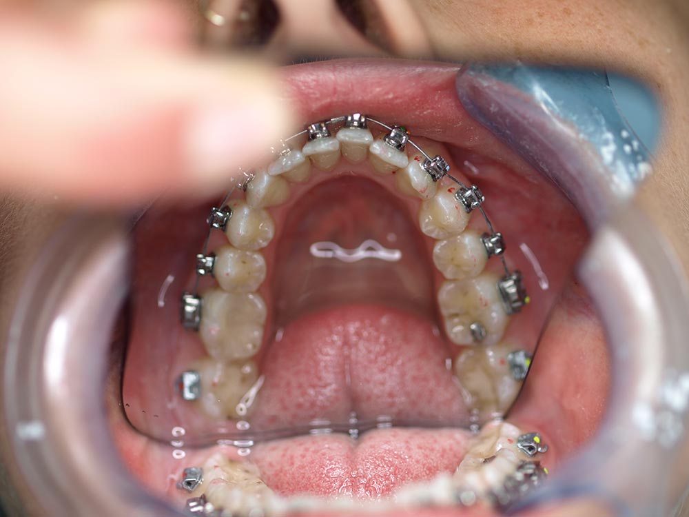 Orthodontic cases