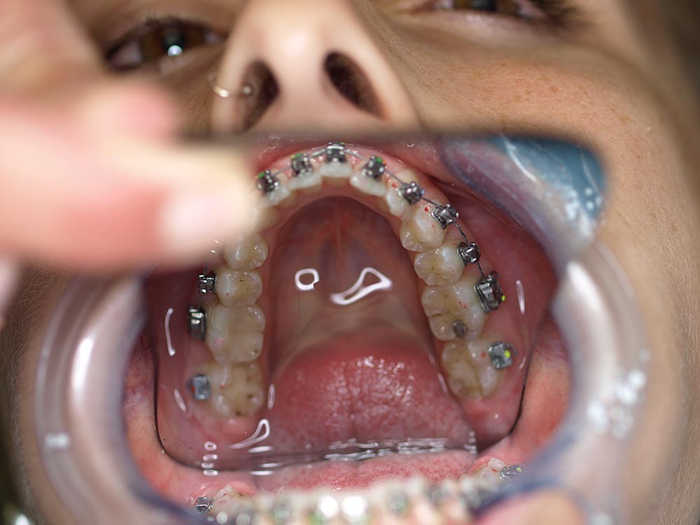 Orthodontic cases