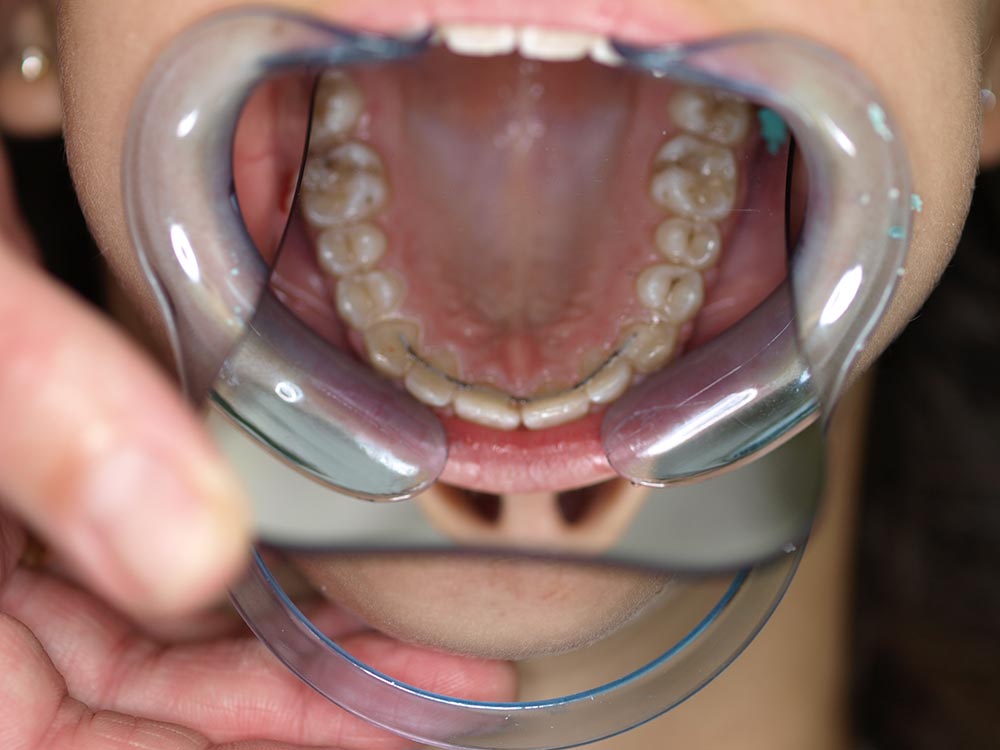 Orthodontic cases