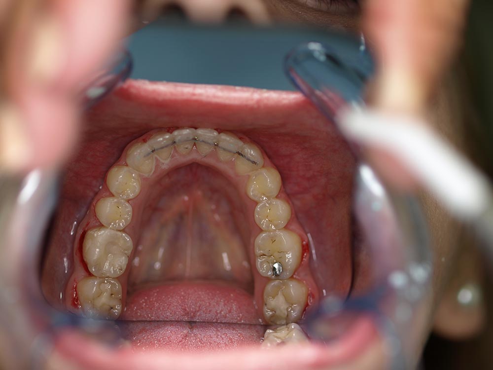 Orthodontic cases