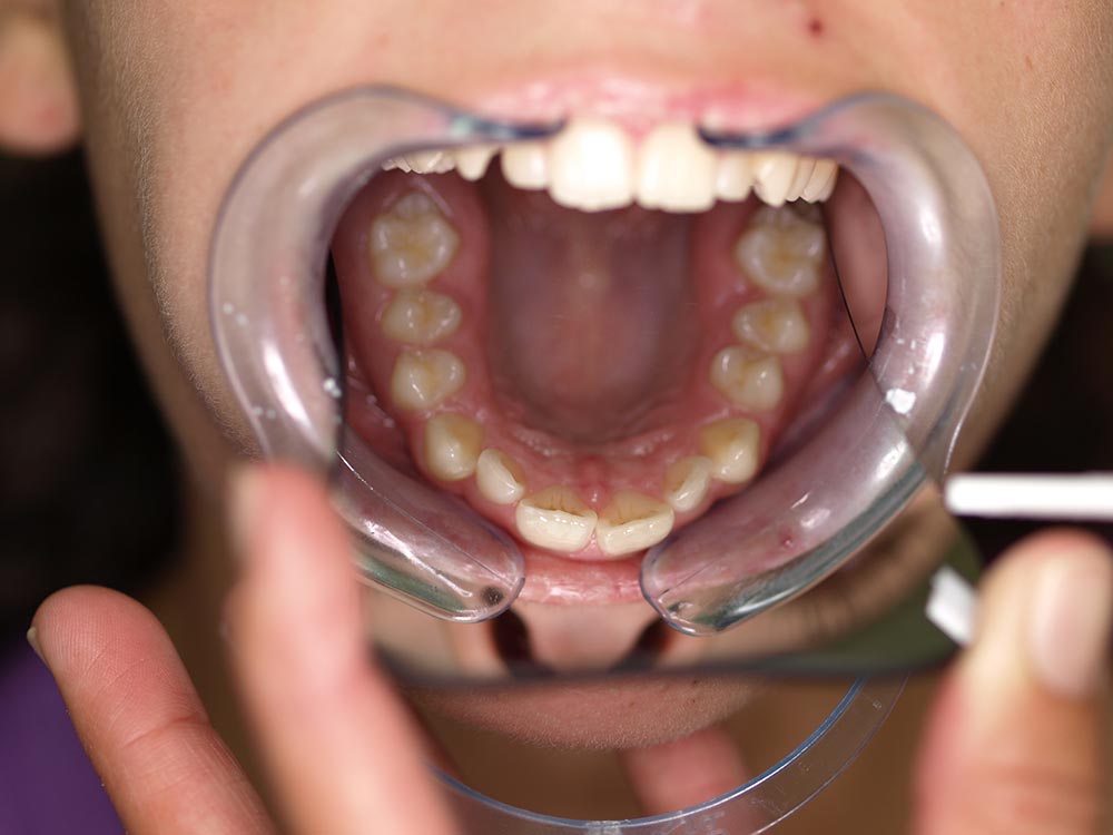 Orthodontic cases