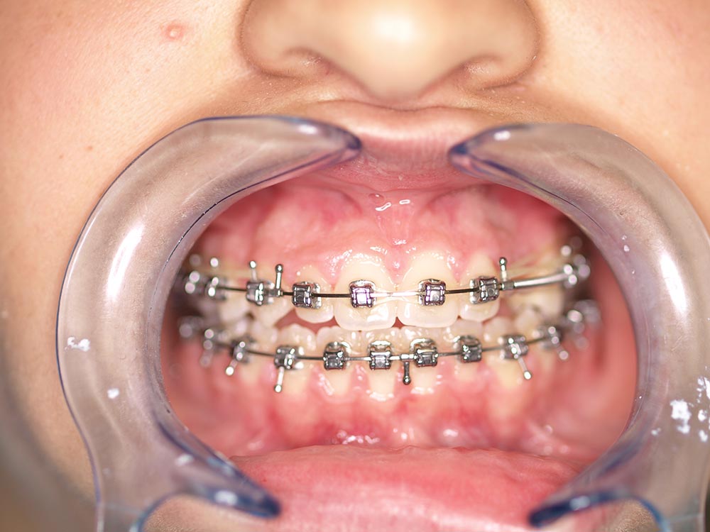 Orthodontic cases