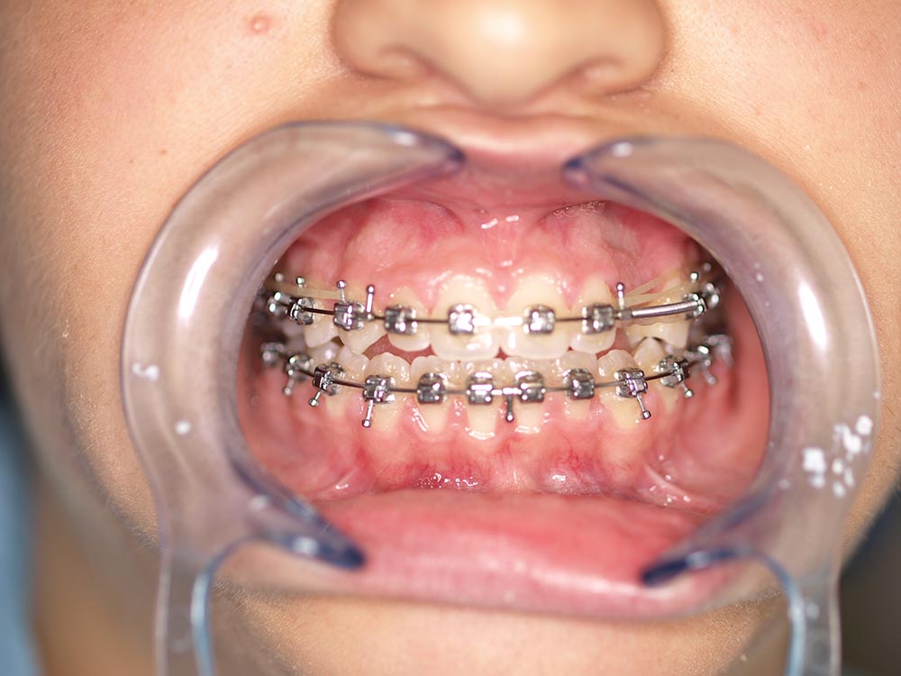 Orthodontic cases