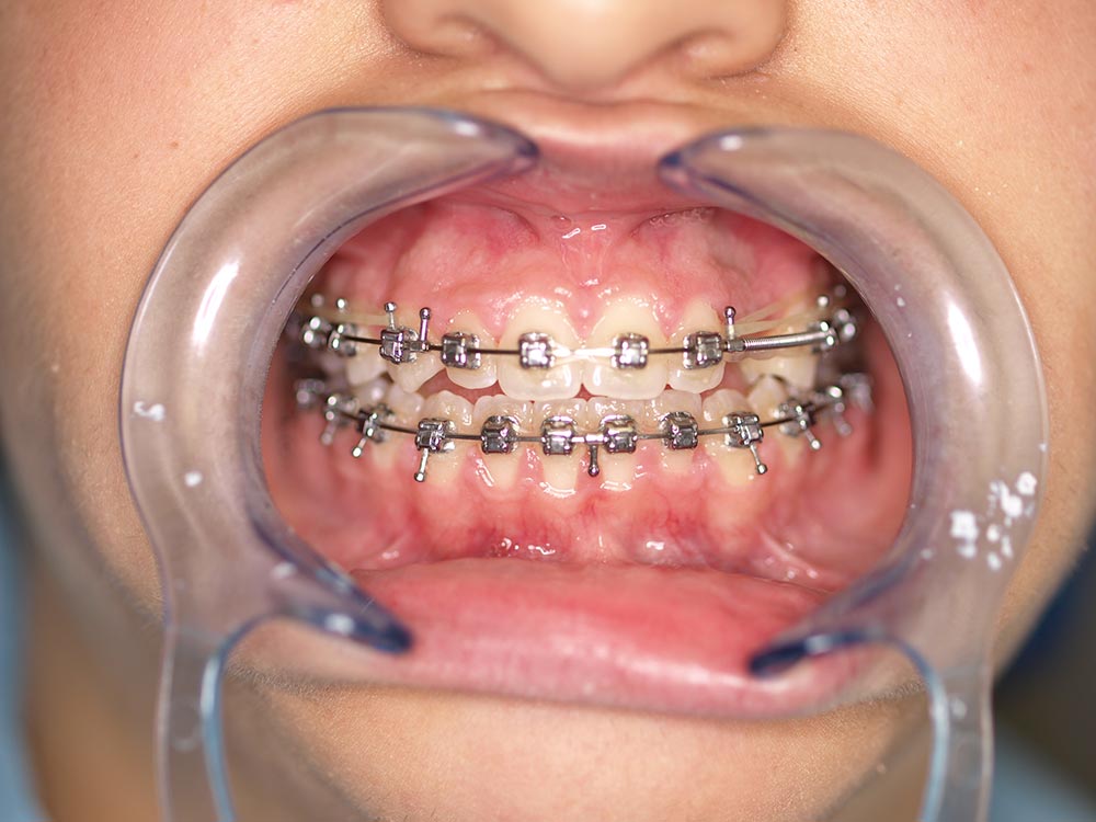 Orthodontic cases