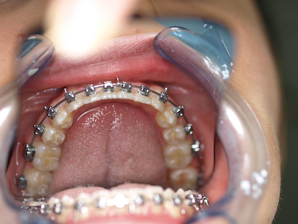 Orthodontic cases