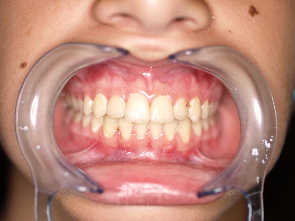 Orthodontic cases